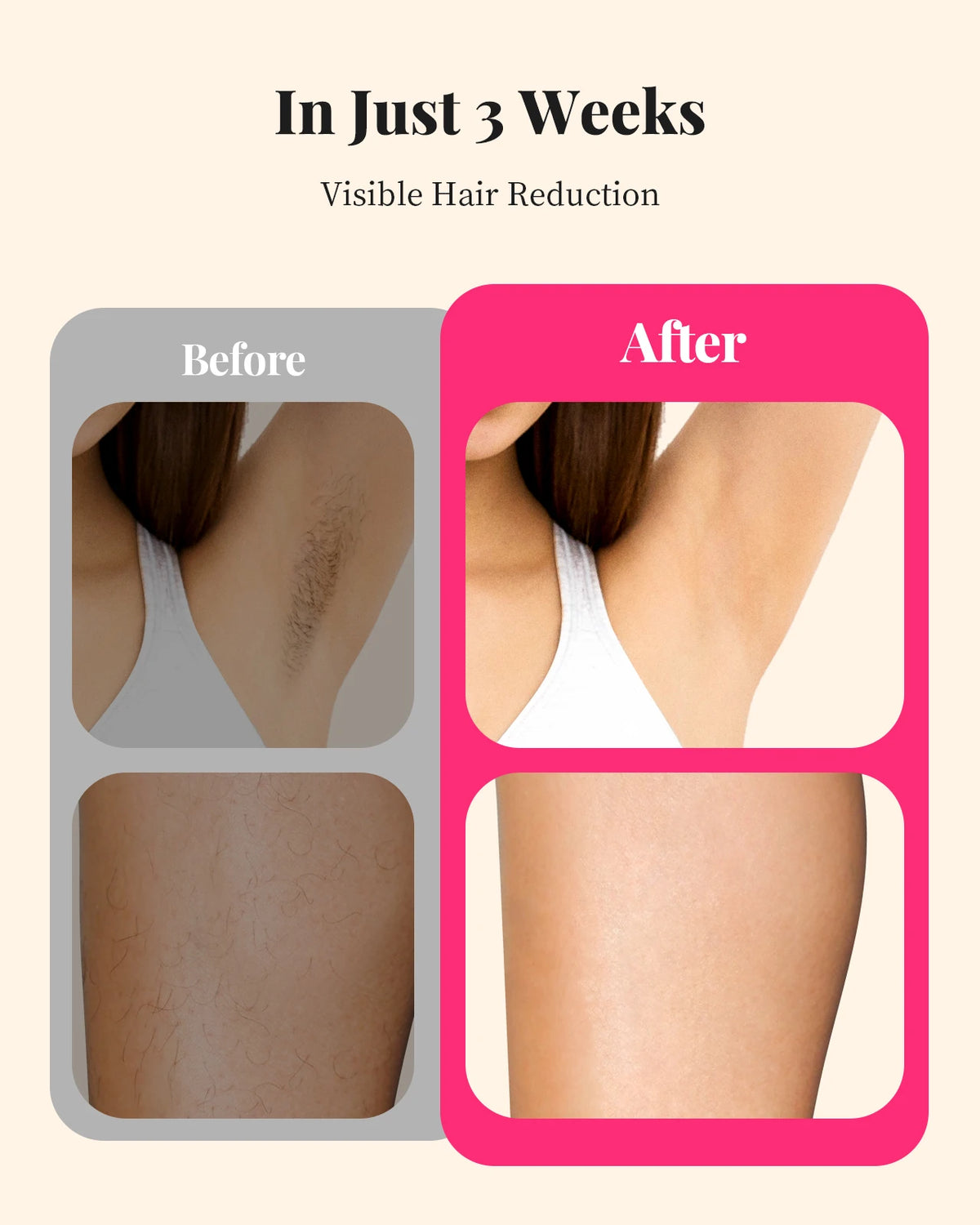 Totmizby IPL Hair Removal Device for Face Body and Bikini