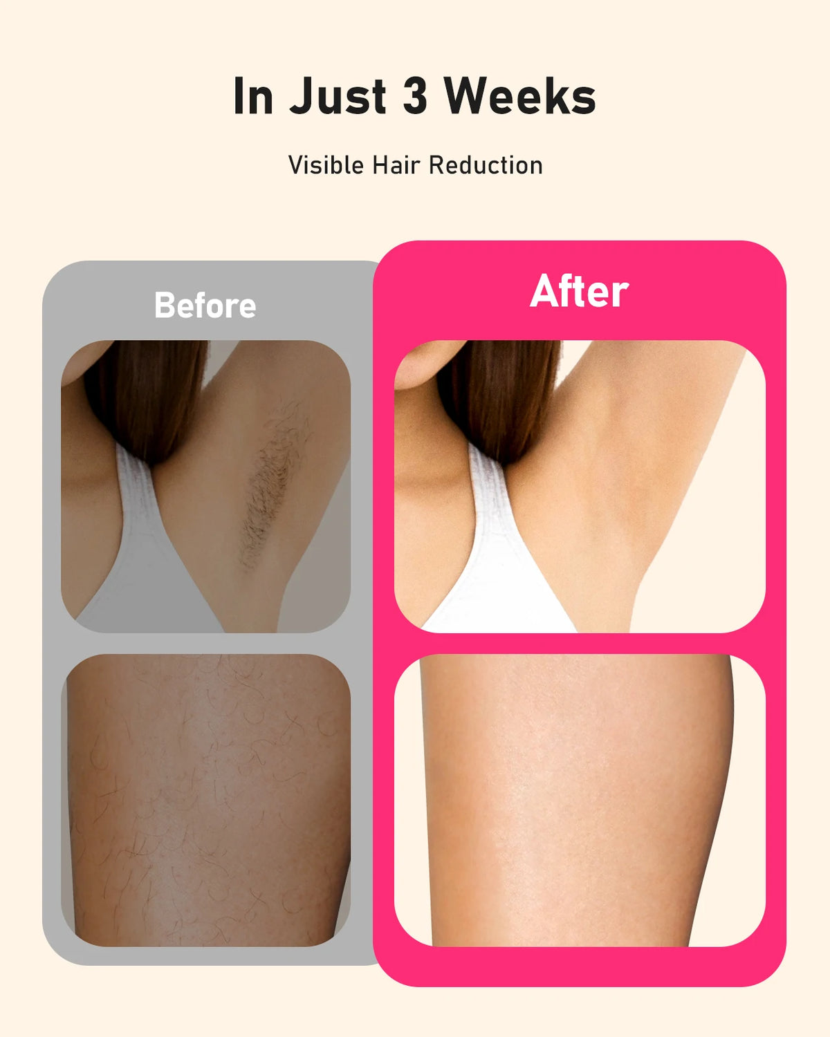 JOOYEE IPL Permanent Hair Removal Device For Face And Body